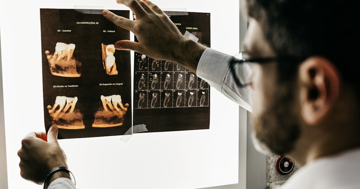 Dente Siso: Quando Extrair e Quando Manter — Guia Completo